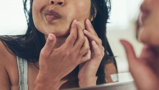 How to Treat PCOS Naturally